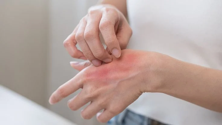 Causes of Aloe Vera Allergy
